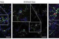 Обнаружена новая причина болезни Альцгеймера
